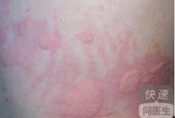 吃瓜过敏皮疹,揭秘过敏源与应对策略