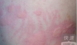 吃瓜过敏皮疹,揭秘过敏源与应对策略