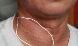 甲亢结节可以吃瓜吗,瓜类食物的适宜摄入