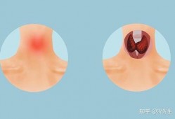 甲亢结节可以吃瓜吗,瓜类食物的适宜摄入