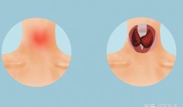 甲亢结节可以吃瓜吗,瓜类食物的适宜摄入